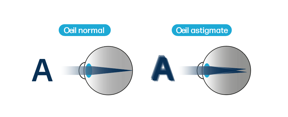 Illustration montrant la différence entre un œil normal et un œil astigmate.