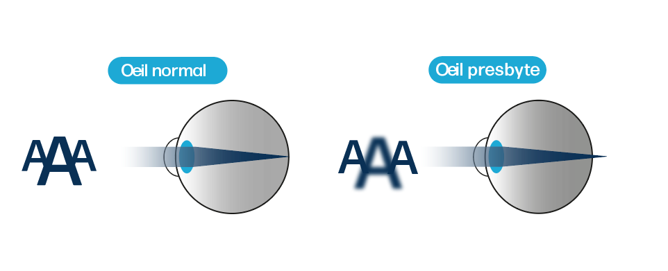 Illustration montrant la différence entre un œil normal et un œil presbyte.