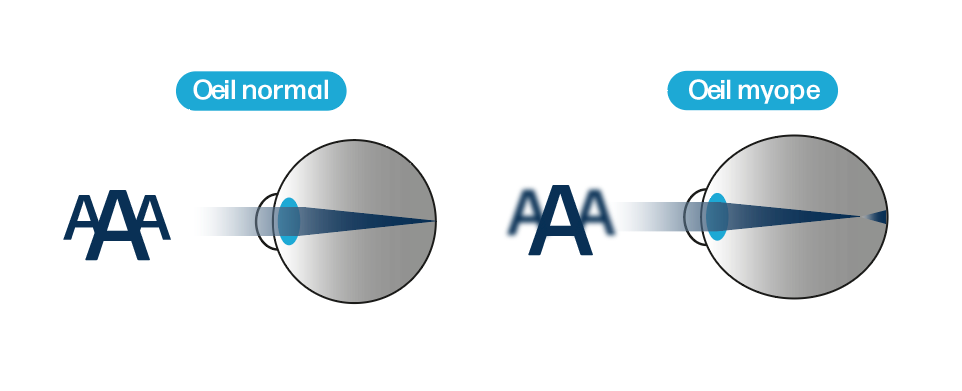 Illustration montrant la différence entre un œil normal et un œil myope.