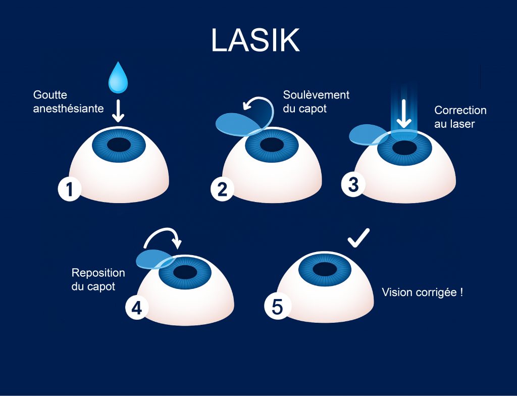 Illustration des étapes de la chirurgie réfractive LASIK : instillation de la goutte anesthésiante, soulèvement du capot cornéen, correction au laser, et reposition du capot et vision corrigée.