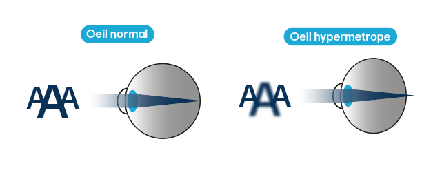Comparaison Oeil Normal Oeil Hypermetrope Phenicia Vision